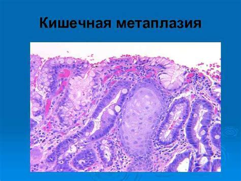 Как определить гастрит с кишечной метаплазией?