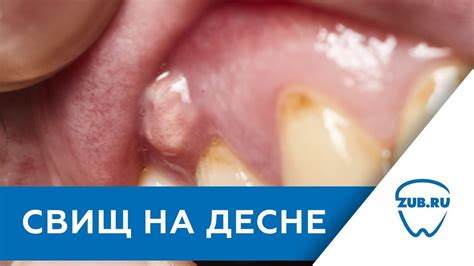 Как определить гнойный шарик на десне