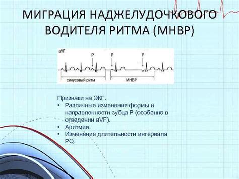 Как определить наличие наджелудочкового ритма?