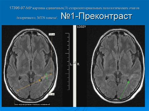 Как определить наличие очагов вторичного генеза?