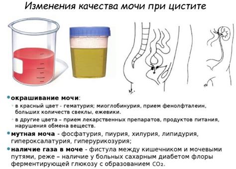 Как определить наличие цистита