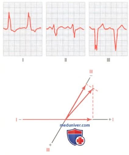 Как определить отклонение параметров QRS в отведении aVR?