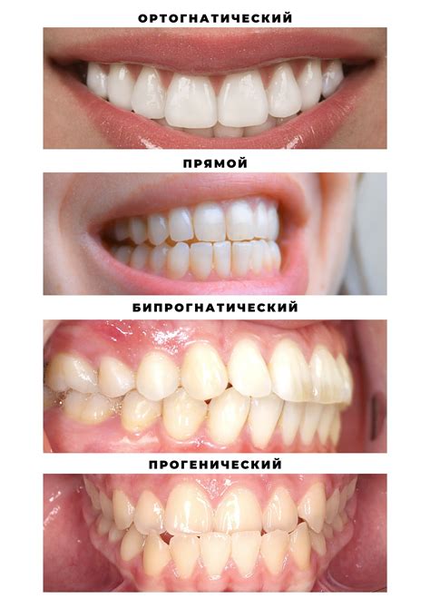 Как определить прикус змеи