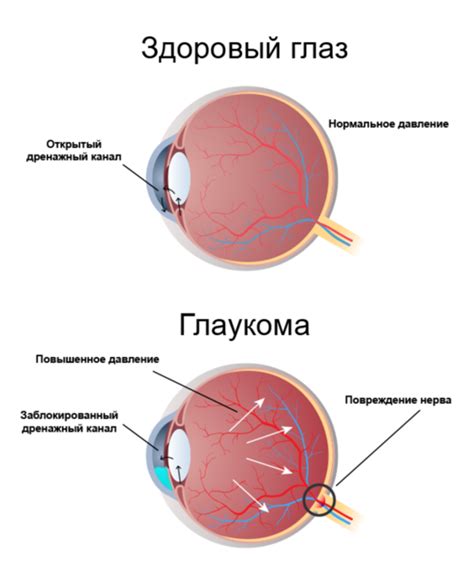 Как определить приступ глаукомы