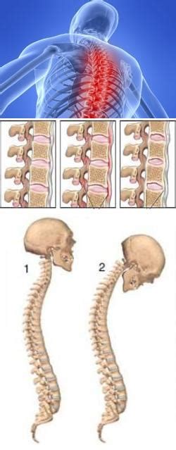 Как определить симптомы неспецифического спондилоартрита?