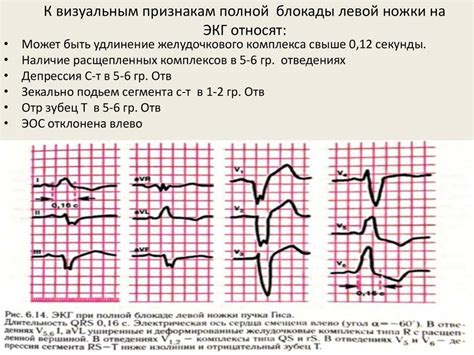 Как определить степень тяжести неполной блокады ПНПГ при ЭКГ у ребенка?