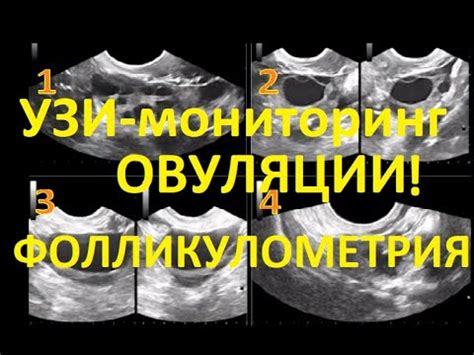 Как определить узи признаки овуляции с помощью УЗИ?