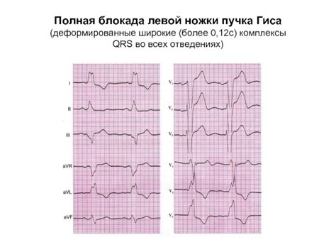 Как определить частичную блокаду правого пучка Гиса