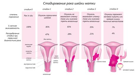 Как определяется стадия онкологии?