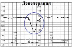 Как осуществляется интерпретация нижней линии на КТГ