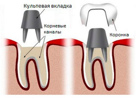 Как осуществляется процедура установки коронки зубные?