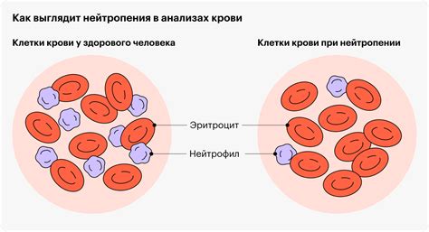 Как понять, что у вас развивается нейтропения