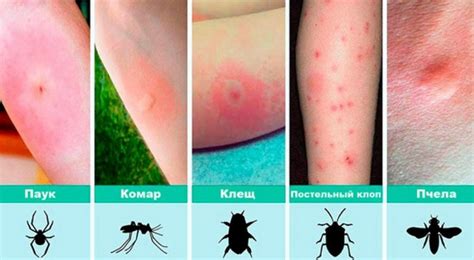 Как поступить при аллергической реакции на укус насекомого