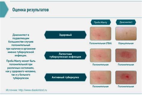 Как правильно интерпретировать результаты манту теста?