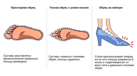 Как предотвратить Стопу Мортона