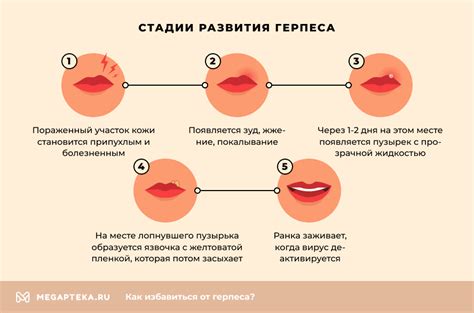 Как предотвратить гноящийся герпес: полезные советы