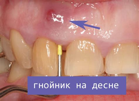 Как предотвратить образование гнойничков на десне