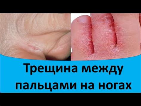 Как предотвратить трещины на коже между пальцами