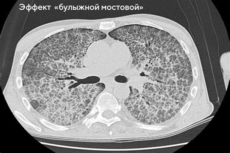 Как проводится КТ4 легких?