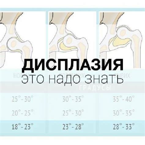 Как проводится УЗИ тазобедренных суставов типа 1а?