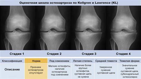 Как проводится диагностика гонартроза коленного сустава 1 степени?