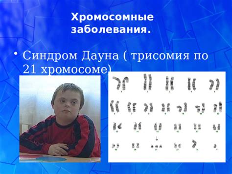 Как проводится диагностика моносомии по 21 хромосоме?