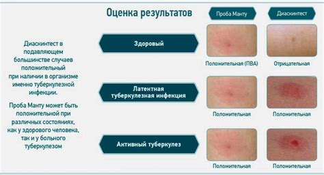 Как проводится диагностика отрицательного результата манту?