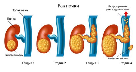 Как проводится диагностика пиелонефрита