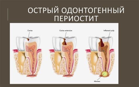 Как проводится лечение одонтогенных инфекций?