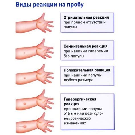 Как проводится манту: подготовка и процесс