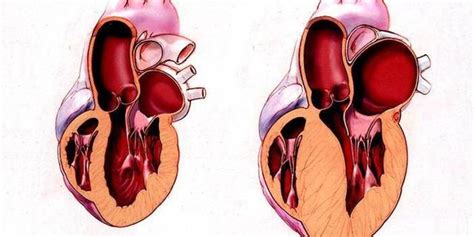 Как происходит атрофия левого желудочка сердца?