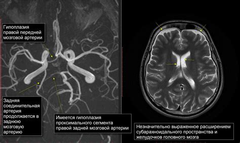 Как происходит диагностика гипоплазии правой передней мозговой артерии