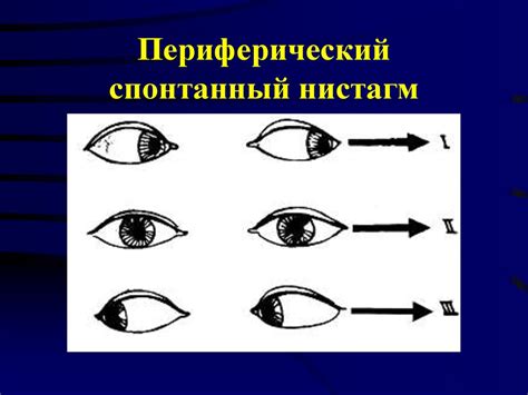 Как происходит диагностика горизонтального нистагма