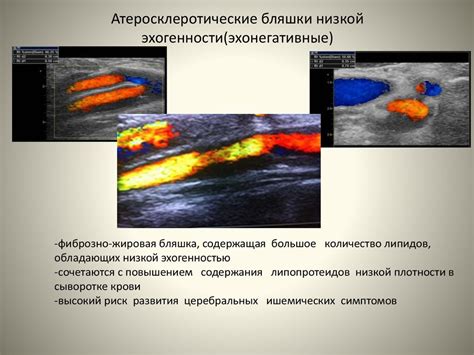 Как происходит диагностика низкой эхогенности