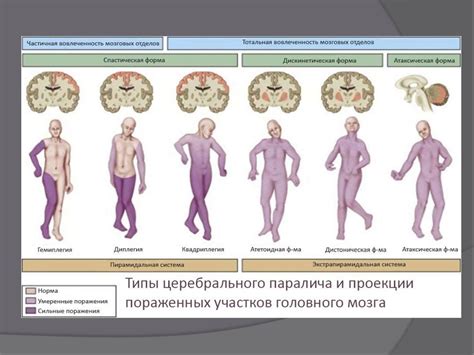 Как происходит диагностика паралича ног?