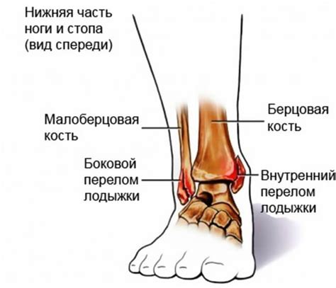 Как происходит лечение перелома голеностопа