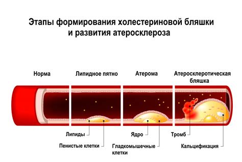 Как происходит потеря бляшки БКБШ