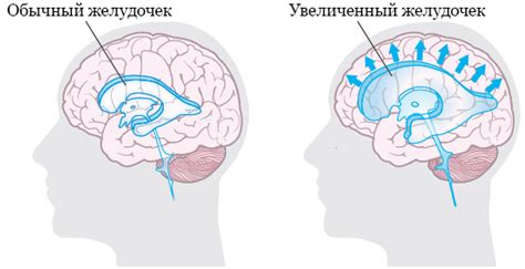 Как происходит проведение операции по установке лево-правого шунта