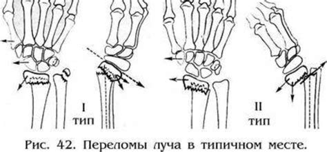 Как происходит процесс смещения при переломе?