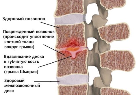 Как происходит развитие грыжи шморля?