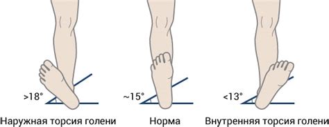 Как происходит торсия голени: механизм развития