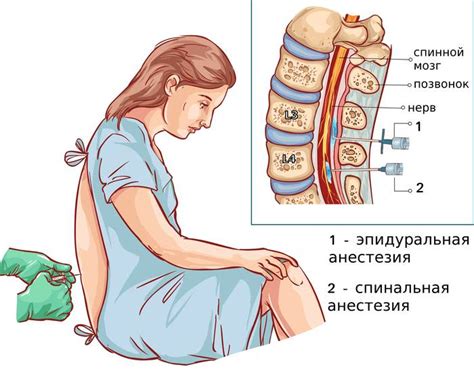 Как происходит эпидуральная анестезия?