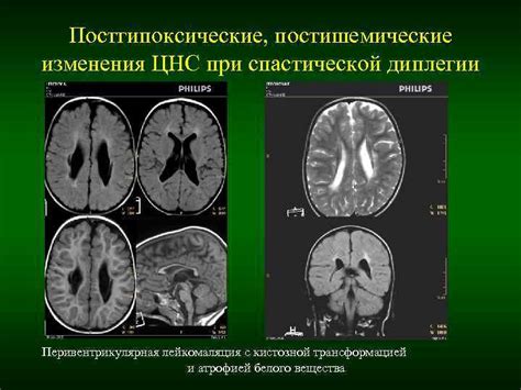 Как происходят постишемические изменения головного мозга?