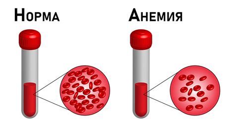 Как проявляется гипохромная микроцитарная анемия?