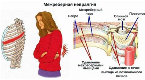 Как проявляется невралгия с левой стороны у сердца