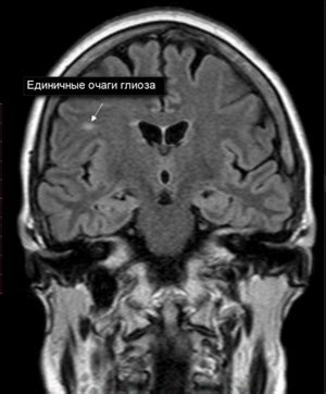 Как проявляются мелкие очаги глиоза?