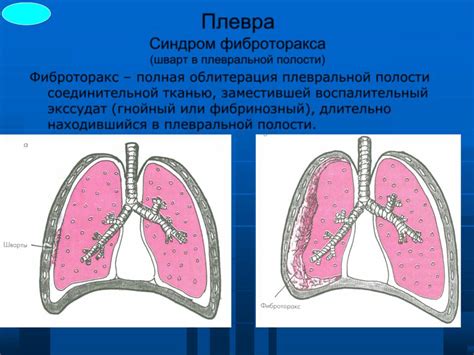 Как проявляются плевральные спайки