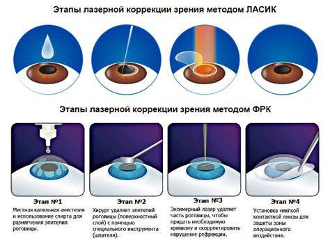 Как работает лазерная коррекция глаз