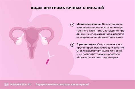 Как работает спираль для женщины?