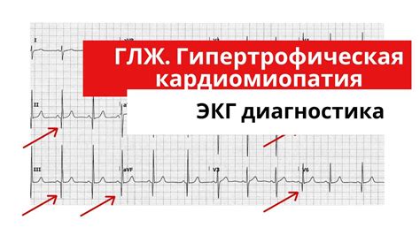 Как распознать дилатацию ЛЖ на ЭКГ